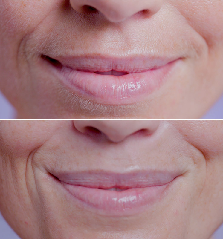 Before and After